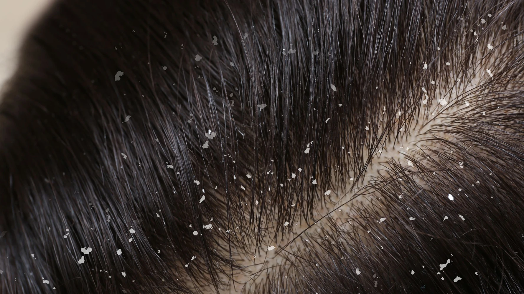 caspa dermatite seborreica